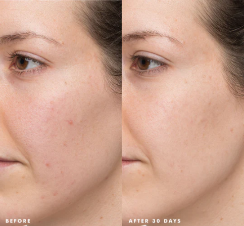 Day Breakthru Salicylic Acid Acne Serum Sample