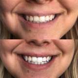 Beaut. Teeth Whitening System